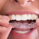 Smile Makeover 101: All About Orthodontics And Straightening Teeth